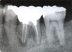 歯根・ポストコア・クラウンを一体化した破折歯のオールセラミック修復術前